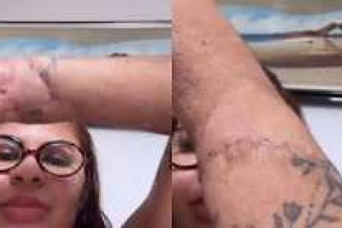 QUIXERAMOBIM - ‘Marcas do meu milagre’: Ana Clara mostra cicatrizes após reimplante das mãos